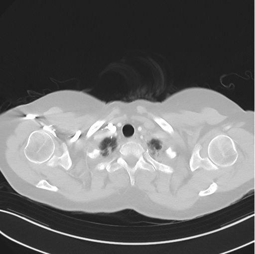 File:Cerebral abscess from pulmonary arteriovenous malformation (Radiopaedia 86275-102292 Axial lung window 8).png