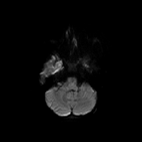 File:Cerebral abscess post cardiac surgery (Radiopaedia 27244-27420 Axial DWI 1).jpg