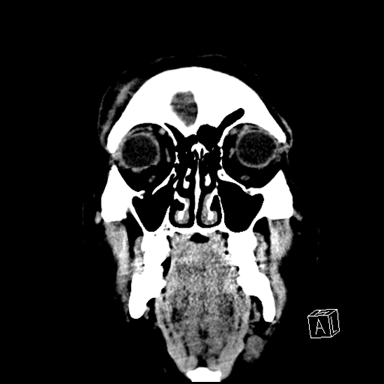 File:Cerebral abscess with ventriculitis (Radiopaedia 78965-91876 B 7).jpg