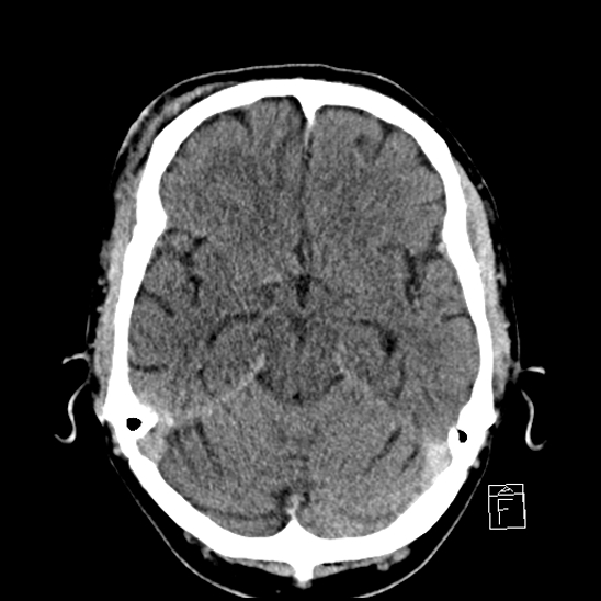 File:Cerebral abscess with ventriculitis (Radiopaedia 78965-91877 A 18).jpg