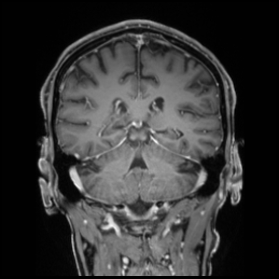 Cerebral abscess with ventriculitis (Radiopaedia 78965-91878 Coronal T1 C+ 41).jpg