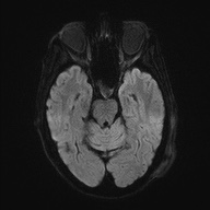 Cerebral amyloid angiopathy-related inflammation (Radiopaedia 74836-85849 Axial DWI 41).jpg