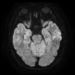 Cerebral amyloid angiopathy (Radiopaedia 28698-28978 Axial DWI 10).jpg