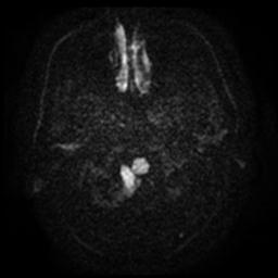 Cerebral amyloid angiopathy (Radiopaedia 28698-28978 Axial DWI 2).jpg