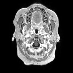 Cerebral amyloid angiopathy (Radiopaedia 29129-29518 Axial T1 C+ 12).jpg