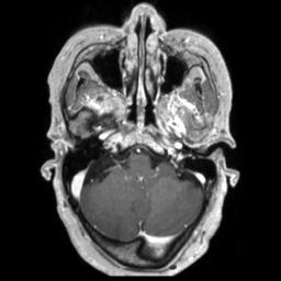 Cerebral amyloid angiopathy (Radiopaedia 29129-29518 Axial T1 C+ 35).jpg