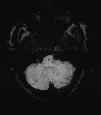 File:Cerebral amyloid angiopathy (Radiopaedia 46082-50433 Axial SWI MIP 13).png