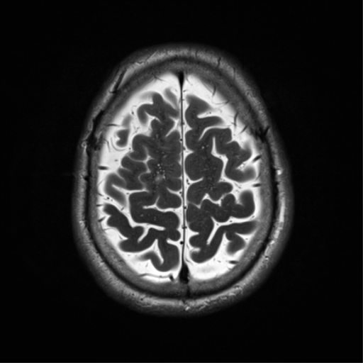 File:Cerebral amyloid angiopathy (Radiopaedia 46082-50433 Axial T2 31).png
