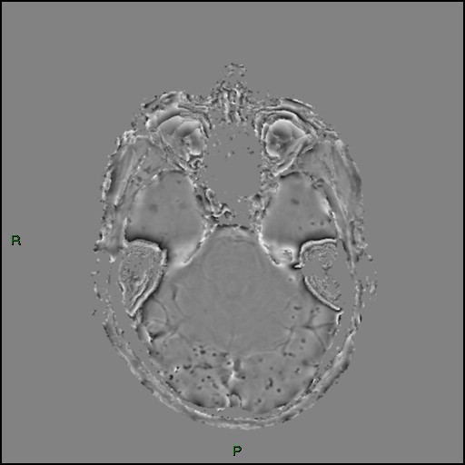 Cerebral amyloid angiopathy (Radiopaedia 77506-89664 H 35).jpg