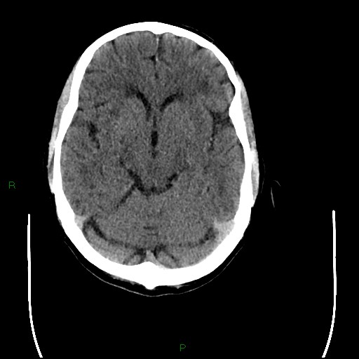 Cerebral amyloid angiopathy (Radiopaedia 77506-89665 Axial non-contrast 42).jpg