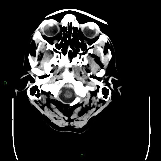 Cerebral amyloid angiopathy (Radiopaedia 77506-89665 Axial non-contrast 8).jpg