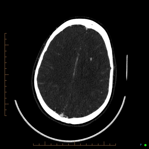 Cerebral arteriovenous malformation (AVM) (Radiopaedia 78162-90706 Axial CTA 191).jpg