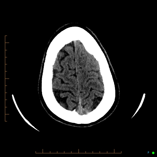 Cerebral arteriovenous malformation (AVM) (Radiopaedia 78162-90706 Axial non-contrast 56).jpg