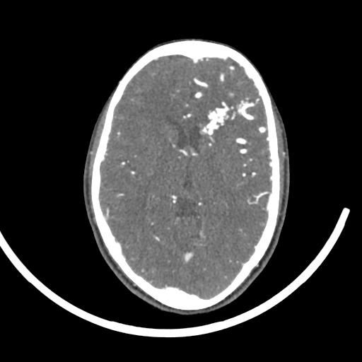 Cerebral arteriovenous malformation (Radiopaedia 29531-30031 E 2).jpg