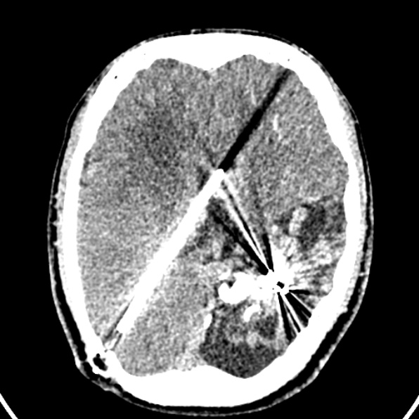 Cerebral arteriovenous malformation (Radiopaedia 37182-39012 Axial non-contrast 28).jpg