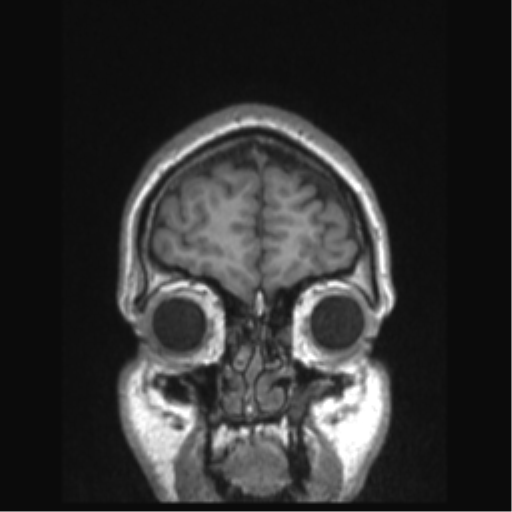 Cerebral arteriovenous malformation (Radiopaedia 39259-41506 Coronal T1 83).png