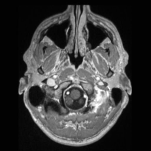 Cerebral arteriovenous malformation (Radiopaedia 55798-62372 Axial T1 C+ 5).png