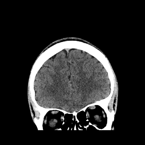Cerebral arteriovenous malformation (Radiopaedia 61964-70028 Coronal non-contrast 15).jpg