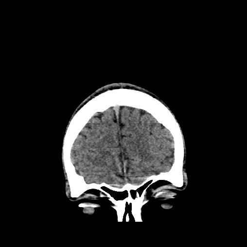 Cerebral arteriovenous malformation (Radiopaedia 61964-70028 Coronal non-contrast 8).jpg