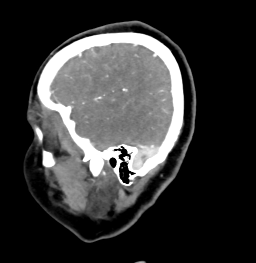 Cerebral arteriovenous malformation (Radiopaedia 73830-84645 D 16).jpg