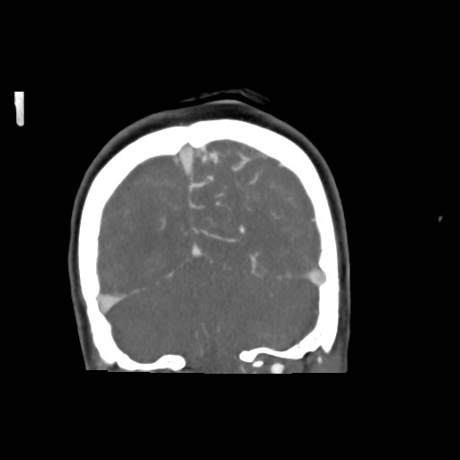 File:Cerebral arteriovenous malformation (Radiopaedia 79677-92888 B 40).jpg