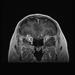 Cerebral arteriovenous malformation (Radiopaedia 84015-99245 Coronal T1 C+ 42).jpg