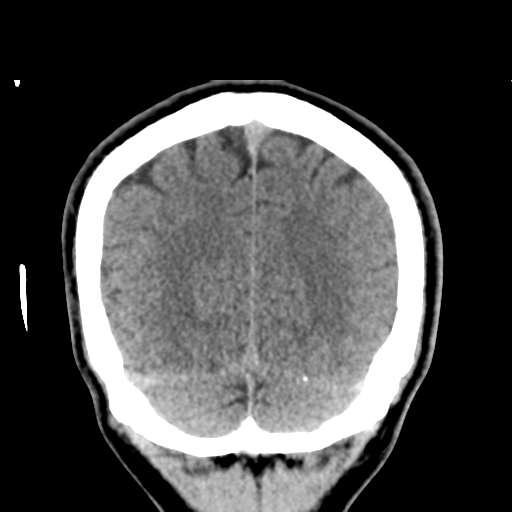 Cerebral arteriovenous malformation (Spetzler-Martin grade 2) (Radiopaedia 41262-44076 Coronal non-contrast 53).png