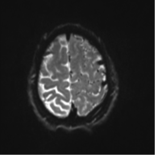 File:Cerebral arteriovenous malformation - huge (Radiopaedia 35734-37272 Axial DWI 20).png