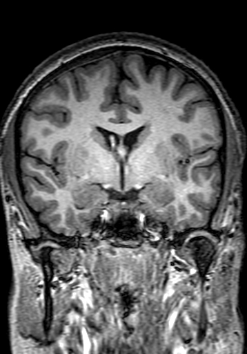 File:Cerebral arteriovenous malformation at posterior body of corpus callosum (Radiopaedia 74111-84925 Coronal T1 143).jpg