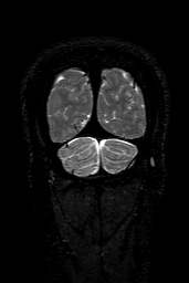 Cerebral arteriovenous malformation at posterior body of corpus callosum (Radiopaedia 74111-84925 Coronal T2 163).jpg