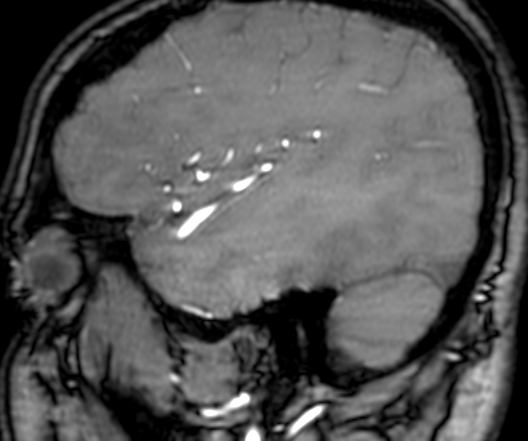 Cerebral arteriovenous malformation at posterior body of corpus callosum (Radiopaedia 74111-84925 J 325).jpg