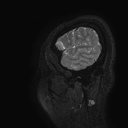 Cerebral arteriovenous malformation at posterior body of corpus callosum (Radiopaedia 74111-84925 Sagittal T2 2).jpg