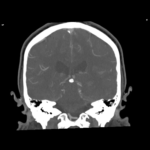 Cerebral arteriovenous malformation with lobar hemorrhage (Radiopaedia 35598-57216 C 57).jpg