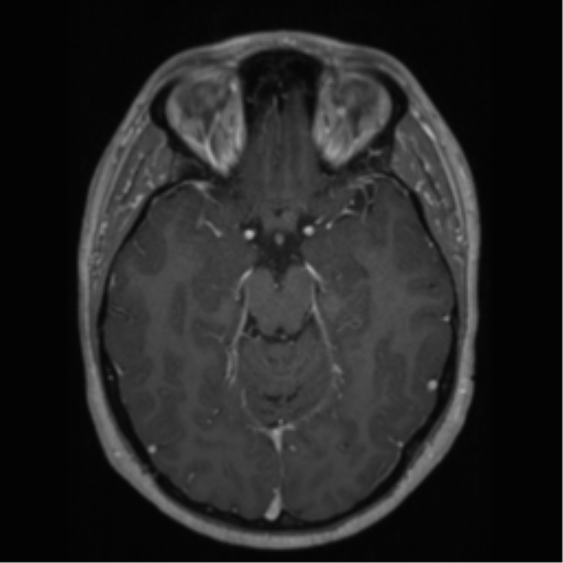 Cerebral cavernoma and development venous anomaly (Radiopaedia 37603-39482 Axial T1 C+ 30).png