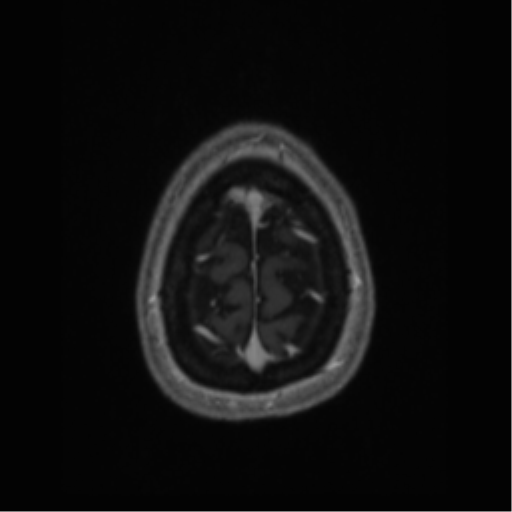 Cerebral cavernoma and development venous anomaly (Radiopaedia 37603-39482 Axial T1 C+ 71).png