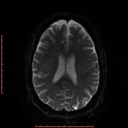 File:Cerebral cavernous malformation (Radiopaedia 26177-26306 Axial DWI 34).jpg