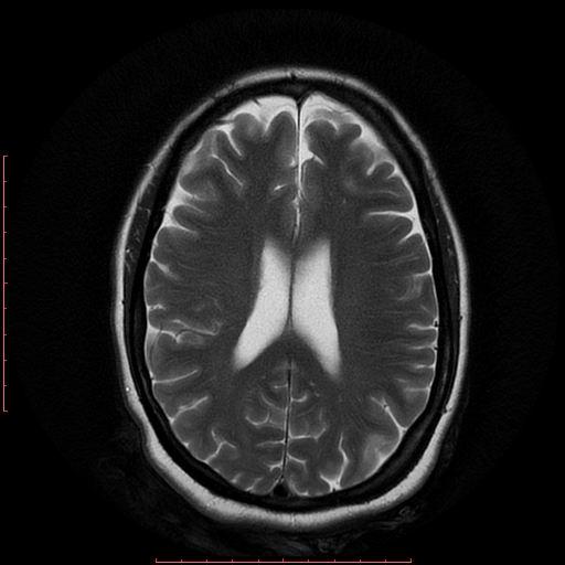 File:Cerebral cavernous malformation (Radiopaedia 26177-26306 Axial T2 14).jpg