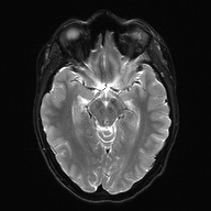 Cerebral cavernous venous malformation (Radiopaedia 70008-80021 Axial DWI 13).jpg