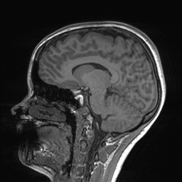 File:Cerebral cavernous venous malformation (Radiopaedia 70008-80021 Sagittal T1 42).jpg
