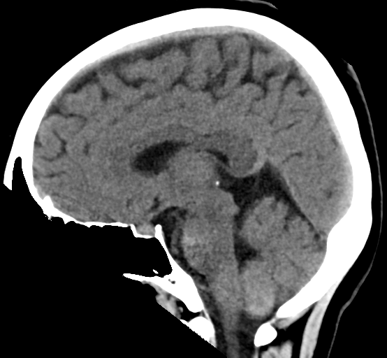 File:Cerebral cavernous venous malformations (Radiopaedia 48117-52945 C 18).png