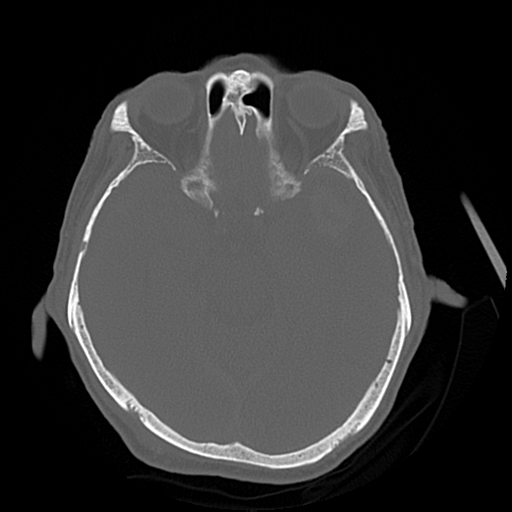 Cerebral contusions, subarachnoid hemorrhage and subdural hygromas (Radiopaedia 55399-61827 Axial bone window 21).png