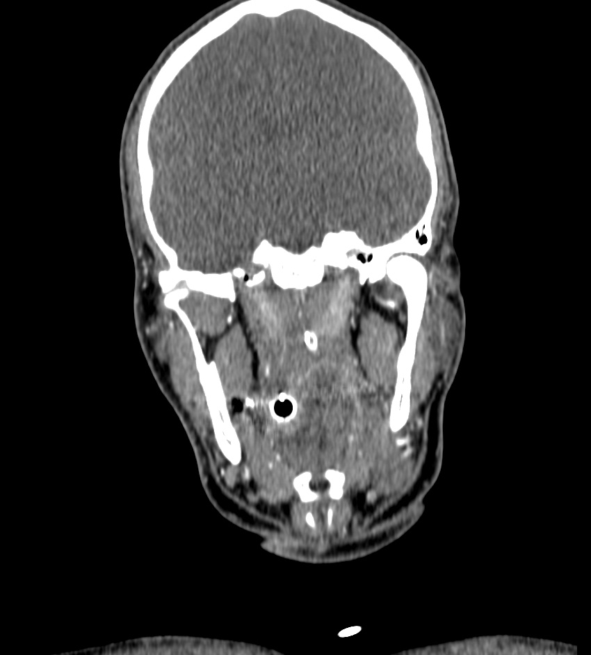 Cerebral edema in an overdose patient (Radiopaedia 72005-82539 B 39).jpg