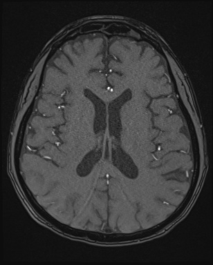 File:Cerebral embolic infarcts (embolic shower) (Radiopaedia 72391-82921 Axial MRA 113).jpg