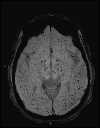 File:Cerebral fat embolism (Radiopaedia 35022-36525 Axial SWI 12).jpg