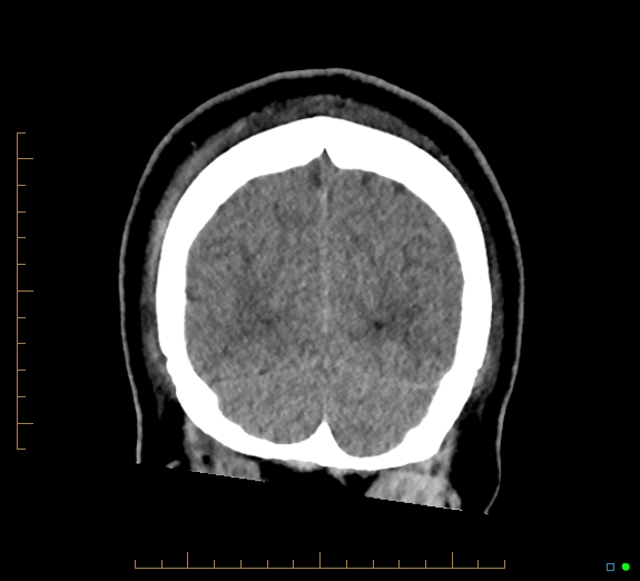 Cerebral fat embolism (Radiopaedia 85521-101224 Coronal non-contrast 53).jpg