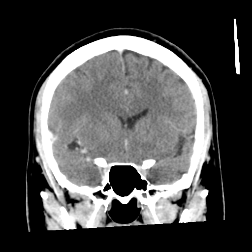 Cerebral hemorrhage secondary to arteriovenous malformation (Radiopaedia 33497-34561 C 25).png