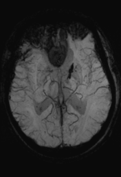 File:Cerebral hemorrhagic contusions- temporal evolution (Radiopaedia 40224-42757 Axial SWI 16).png