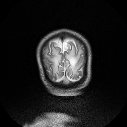 File:Cerebral manifestations of mucopolysaccharidosis type I (Radiopaedia 59171-66487 Coronal T2 21).jpg