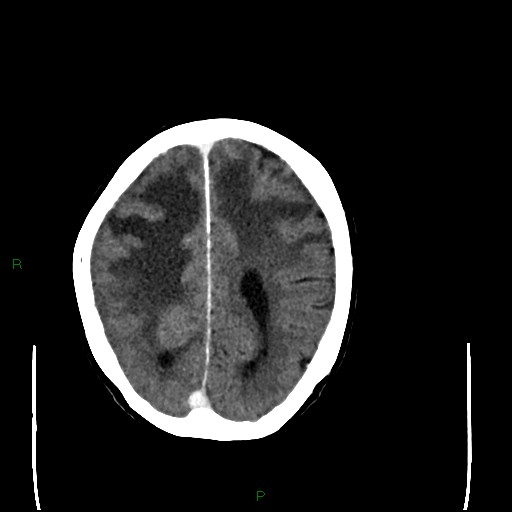 Cerebral metastases - breast primary (Radiopaedia 77653-89857 Axial C+ delayed 82).jpg