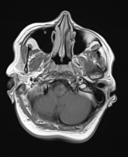 File:Cerebral metastases mimicking abscesses (Radiopaedia 45841-50131 Axial T1 C+ fat sat 5).png